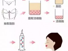 大咖驾到丨脂肪协会会长郑宰昊：一位拥有自体脂肪国际专利的权威大咖！