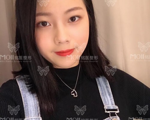 【长春铭医整形案例】元气少女眼，土妞变软妹